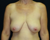 Feel Beautiful - Breast Reduction San Diego 12 - Before Photo